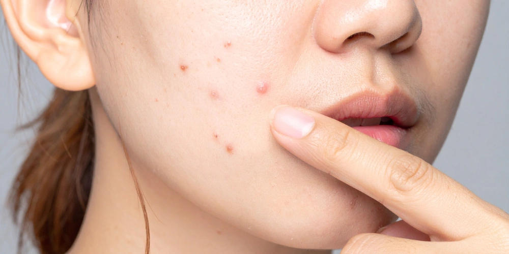 How to remove dark spots on the face naturally