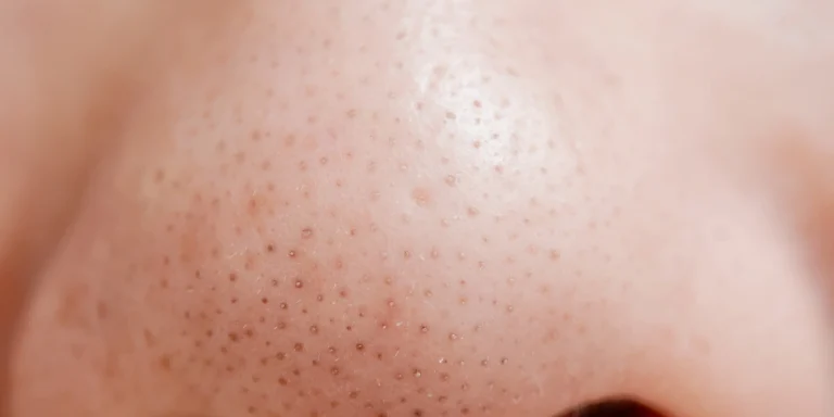 How to control blackheads naturally
