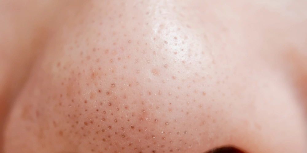 How to control blackheads naturally